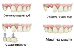 Протезирование зубов в стоматологии «Дента» в Одинцово